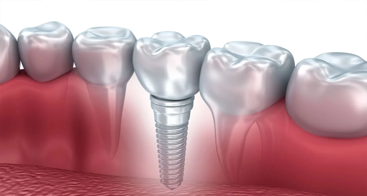 İmplant tedavisi aşamaları nelerdir